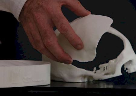 Brasileiros desenvolvem tecnologia de reconstrução craniana