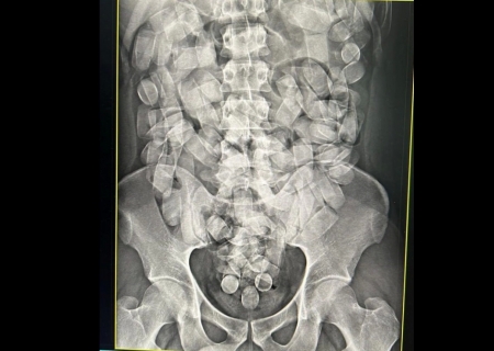 Homem é preso tentando embarcar com 125 cápsulas de cocaína no estômago no aeroporto de Corumbá
