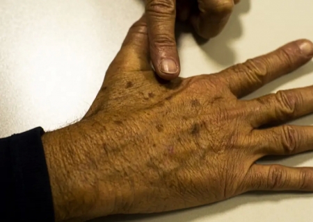 Câncer de pele gera R$ 4,6 mi em custos hospitalares em quase 2 anos