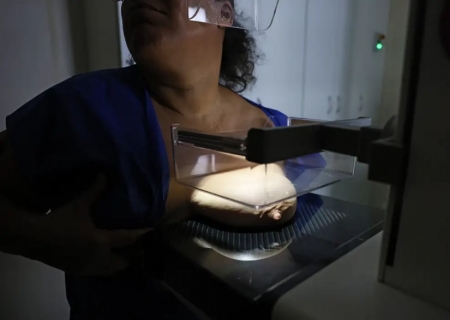 Mamografia avança no Brasil, mas diagnóstico tardio ainda preocupa especialistas